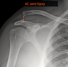 AC Joint Injury X Ray