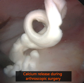 Calcific Tendonitis During Surgery
